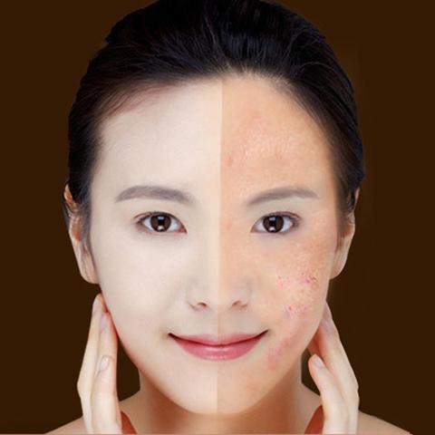 Blue Light Therapy Acne Laser Pen for Scar & Wrinkle Removal